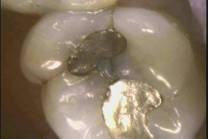 Notice cracks around mercury fillings before removal 